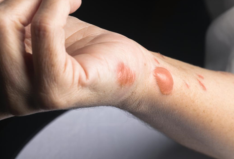 له سوځېدلو وروسته بايد څه وکړو؟