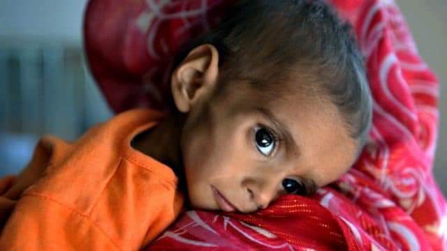 اوچا: ۵۰ سلنه افغان ماشومان د خوارځواکۍ له ګواښ سره مخ دي.