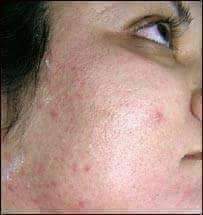 د مخ داغونه